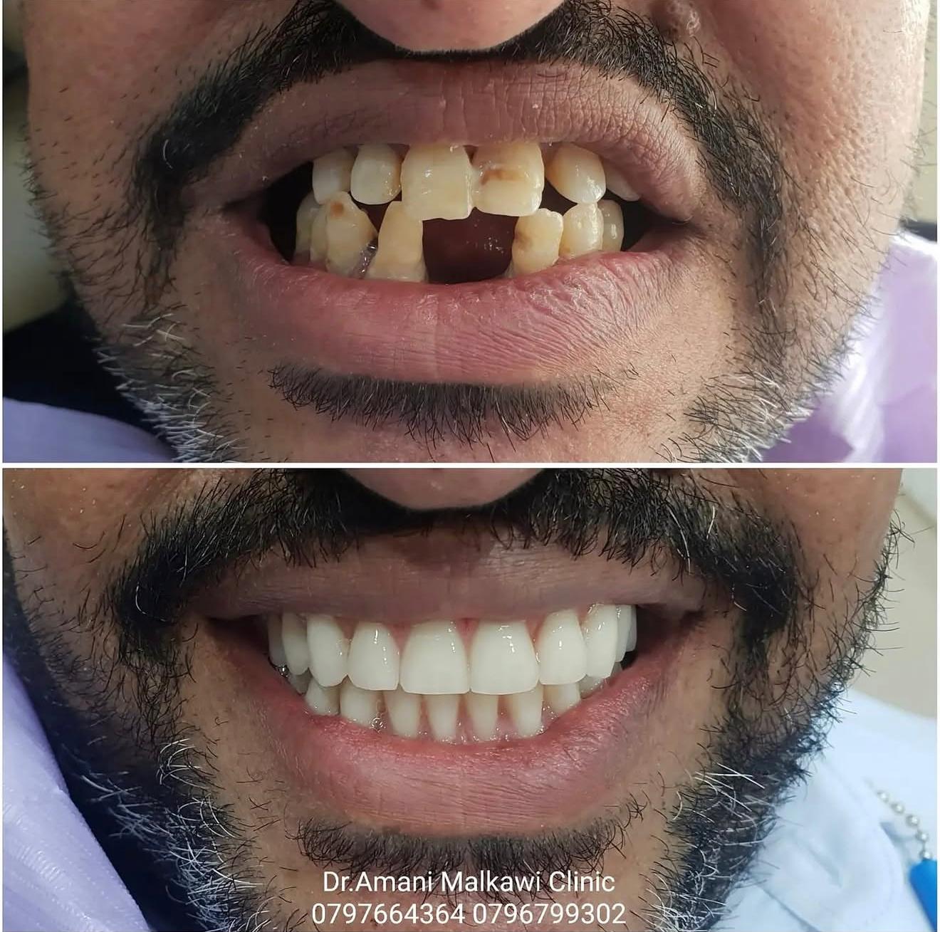 All on 4 Before and After Transformation