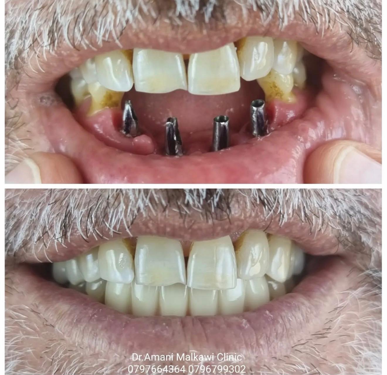 Anterior Dental Implant Case Before and After Amman