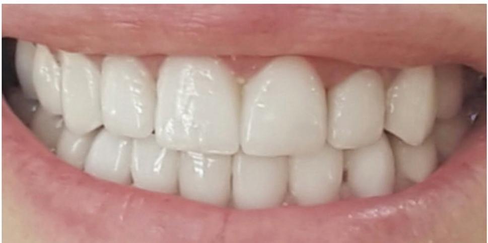 Direct Composite Veneers Amman