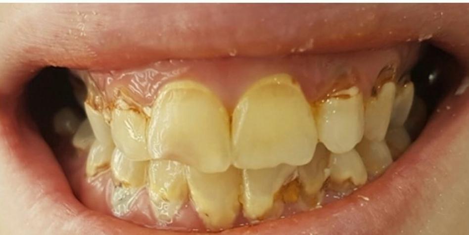 Direct Composite Facing Before Case