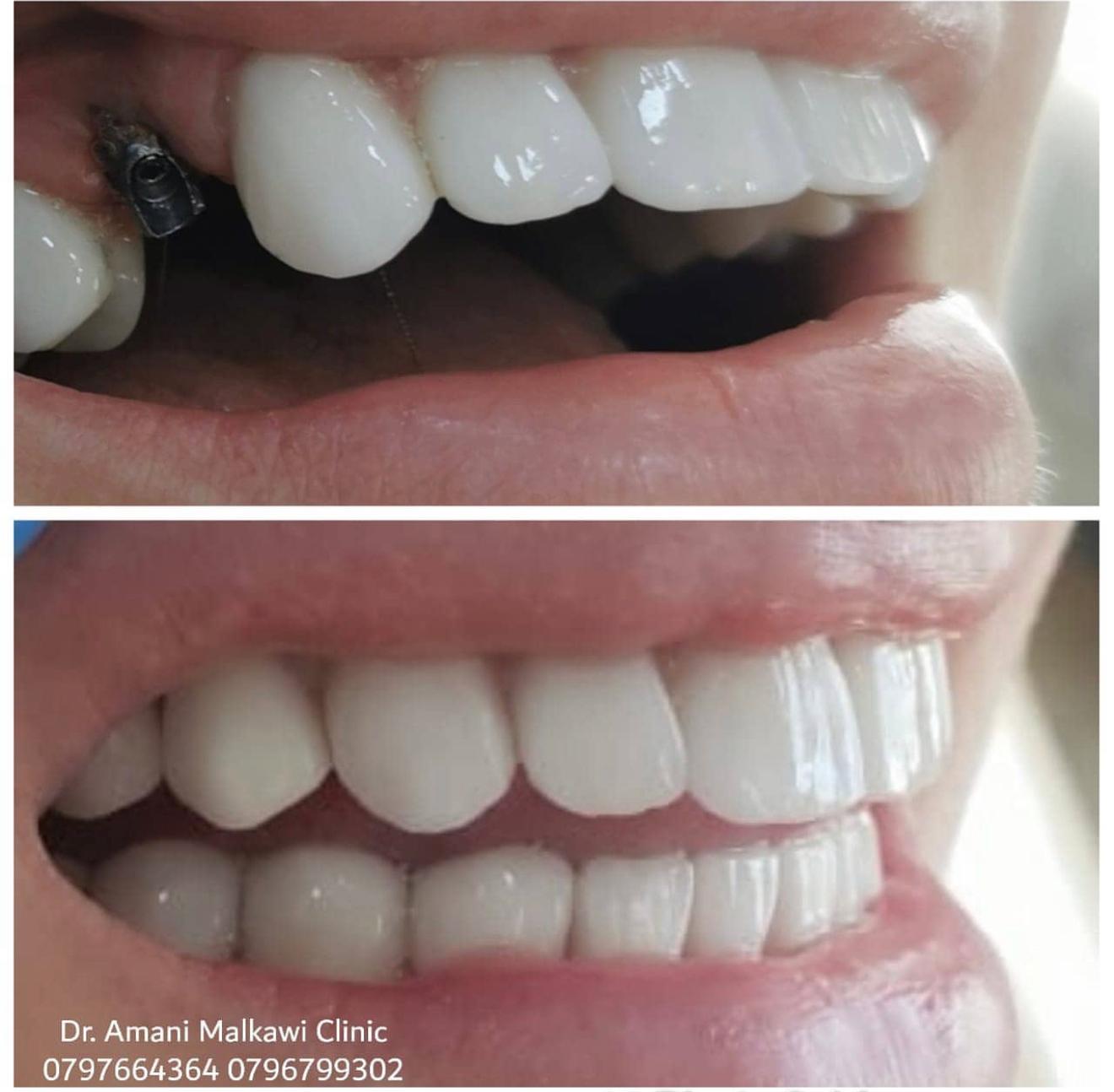 Posterior Dental Implant Case Amman